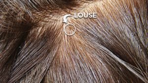 head-louse-in-the-hair