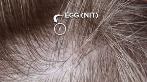 lice-egg-on-hair-shaft